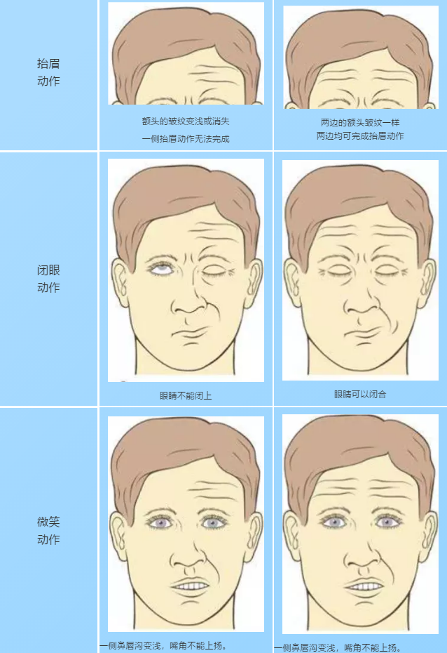 什么是面瘫 简单地说就是面部的表情肌运动出现问题,一般表现是口眼
