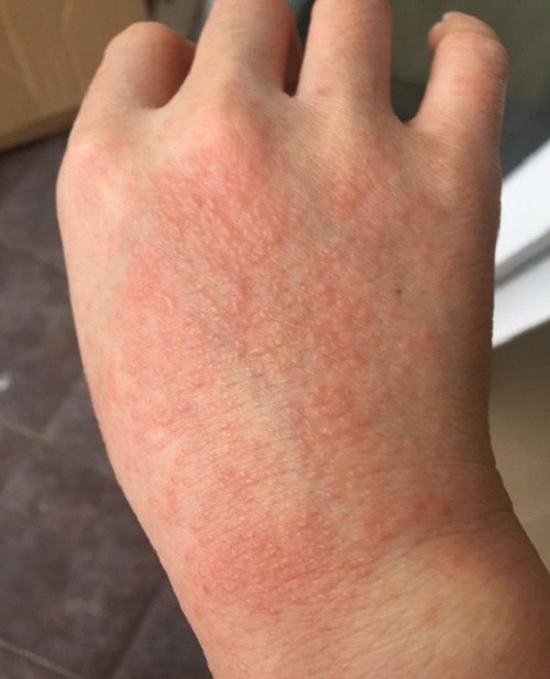 原创战疫日记想到病人需要我满手红疹的痛痒变得微不足道