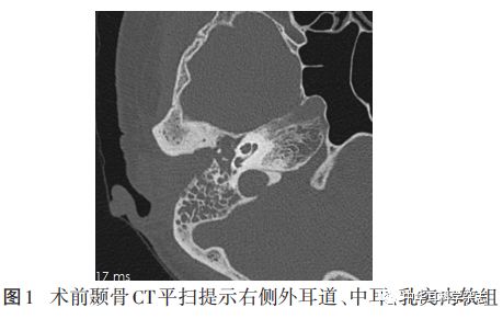 复发外耳道基底细胞癌诊治一例