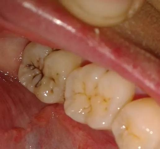患上牙髓炎,再进一步发展就是牙根的炎症了,可能会疼痛,牙肉长脓包,脸