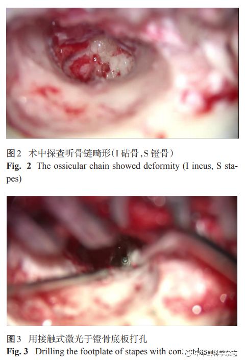 锤骨镫骨连接造孔术治疗先天性中耳畸形1例