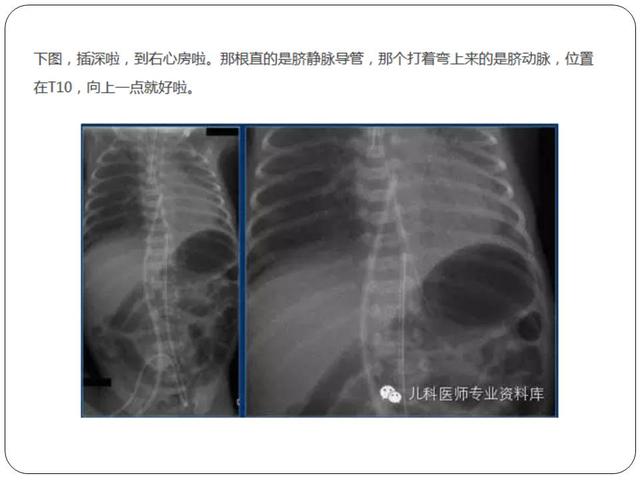 新生儿脐血管导管操作程序