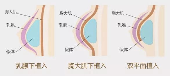 内衣穿不对有什么影响_双瞳症有什么影响吗(2)