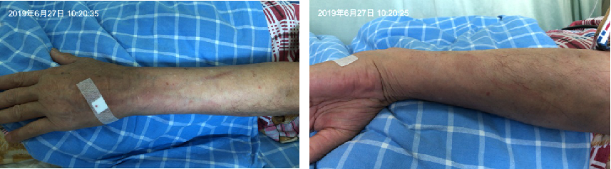 预防静脉炎,静疗专委会只推荐这2种方法_治疗