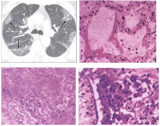 从病理学角度认识并了解病毒性肺炎