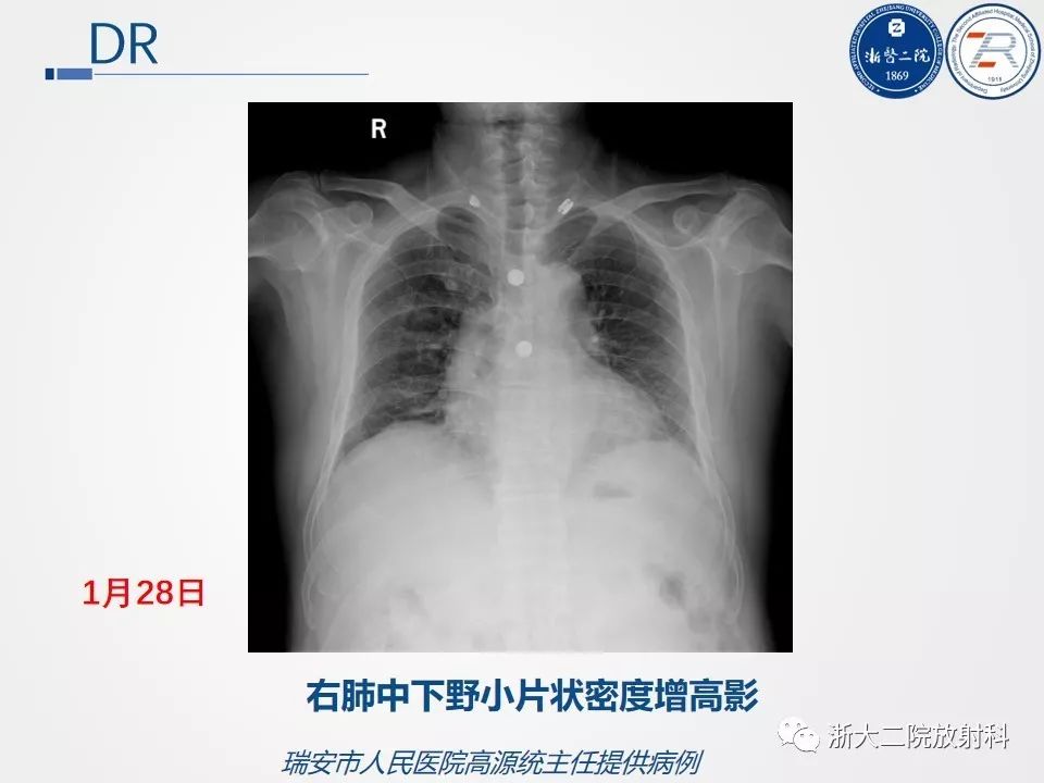 【浙江】新冠状病毒肺炎病例影像总结