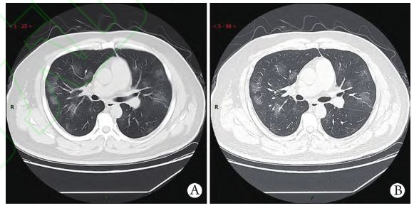 38岁男性患者,新型冠状病毒肺炎,发热,干咳,气短3天,ct提示双肺多发斑