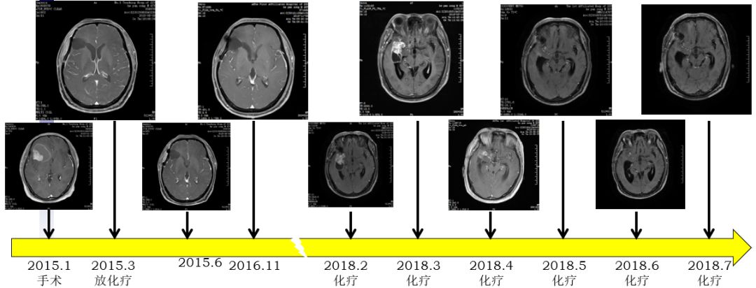 "芳·华"视界 复发高级别胶质瘤的6种治疗方法详述 缘何终选是替莫唑