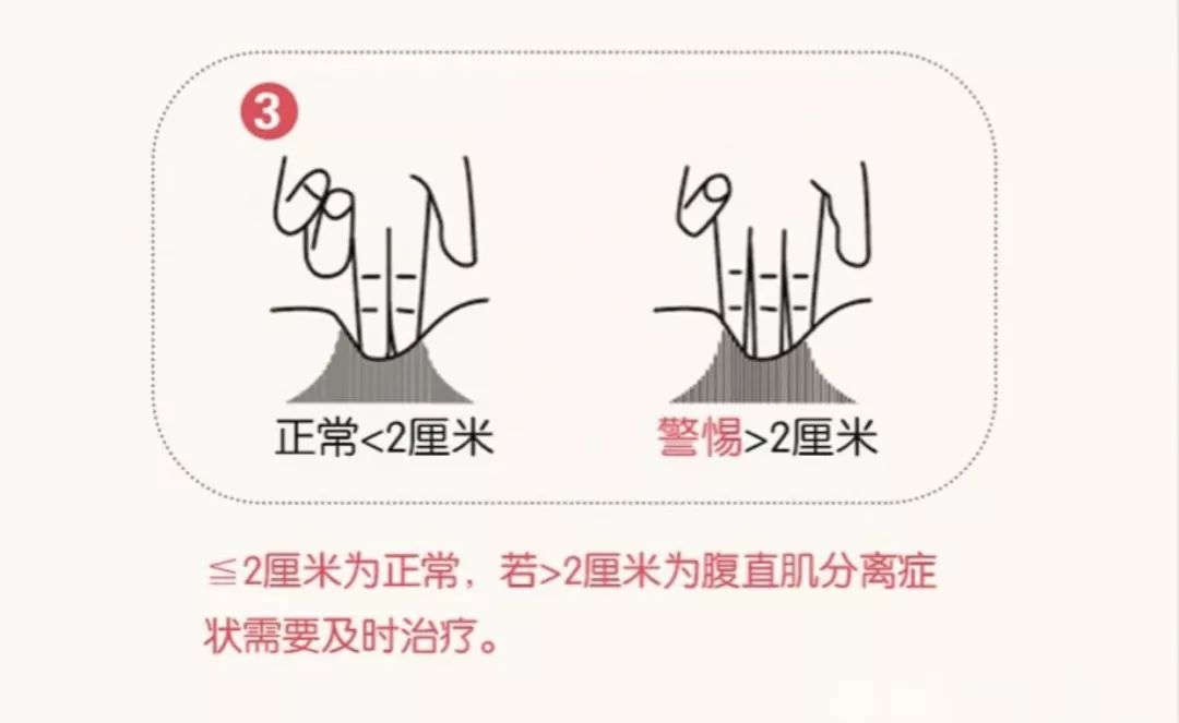 什么时候检测腹直肌分离 bf1a9062f66d4ff282b1a95ceec8c977.jpeg