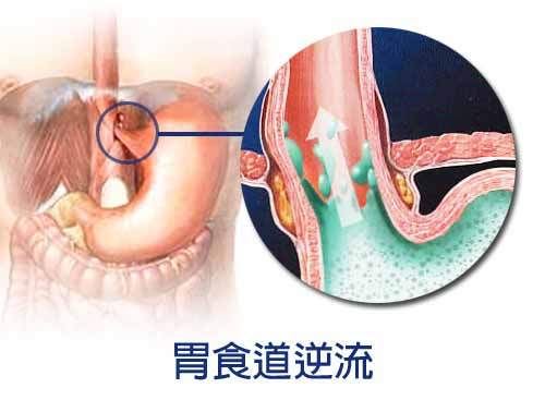 胃嗝气怎么办