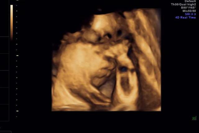 几个月可以做大排畸 e087ea69c64e421e8d036eb9adc3d136.jpeg