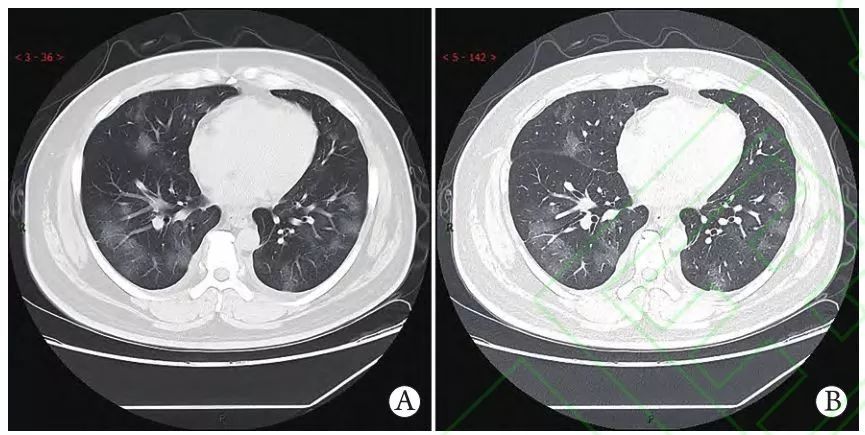 新冠肺炎(covid-19)影像ct,dr,us合集