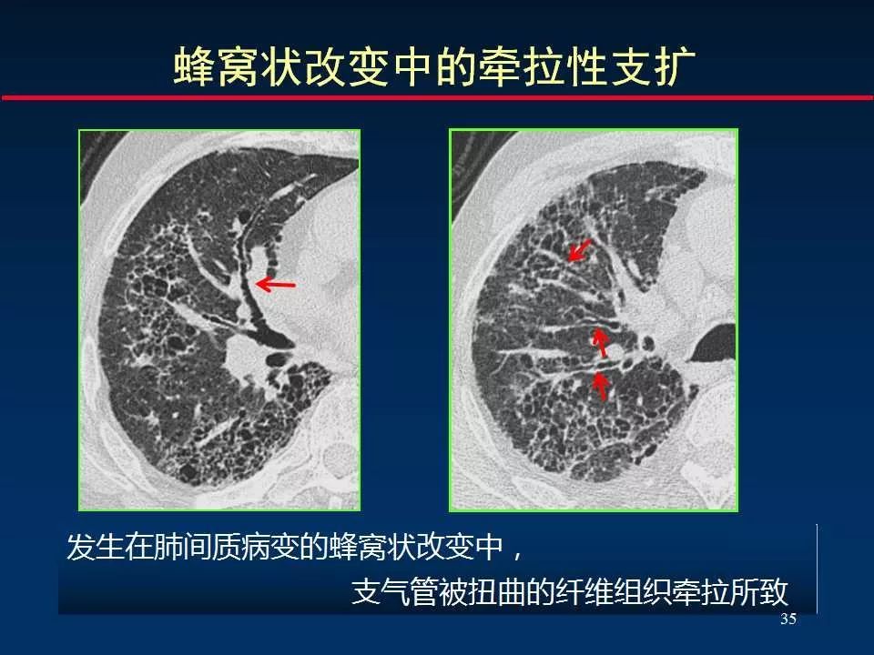 大咖手把手教你判读肺间质改变的ct表现