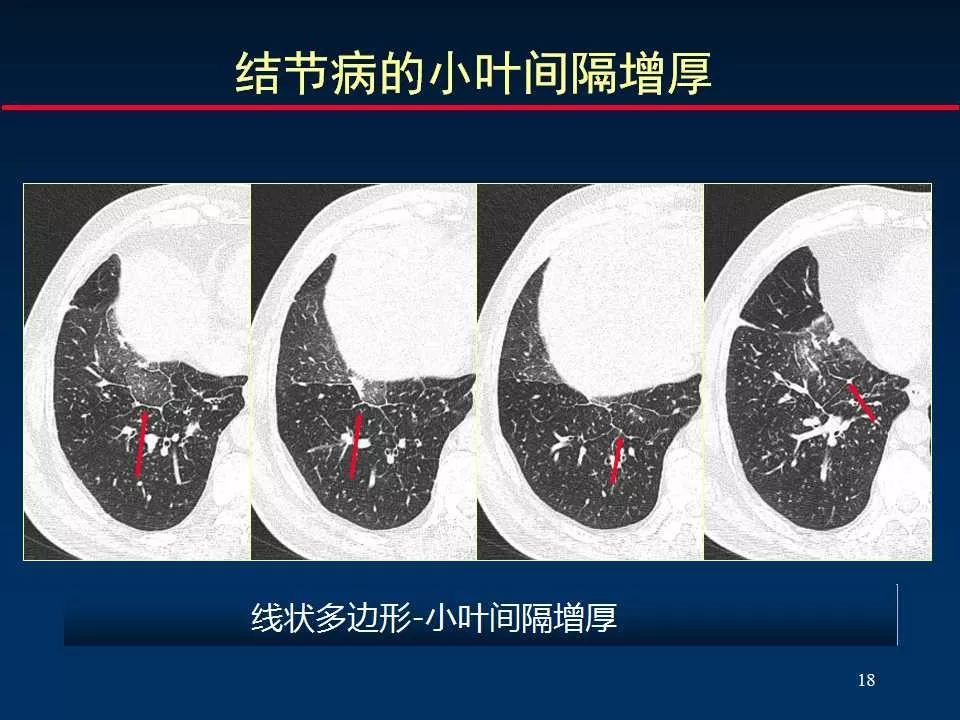 大咖手把手教你判读肺间质改变的ct表现