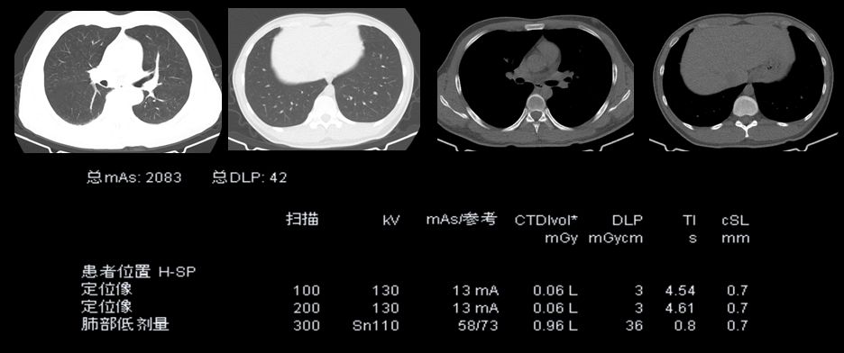 胸部增强ct 来自搜狐网