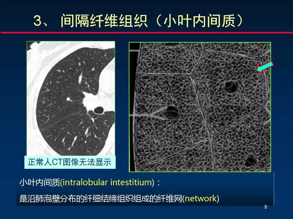 大咖手把手教你判读肺间质改变的ct表现