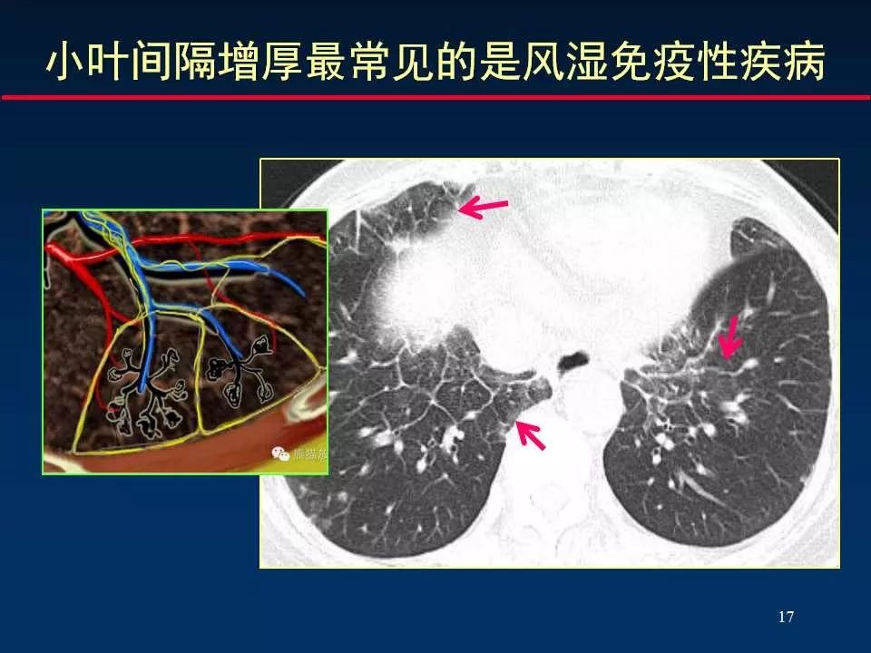 大咖手把手教你判读肺间质改变的ct表现