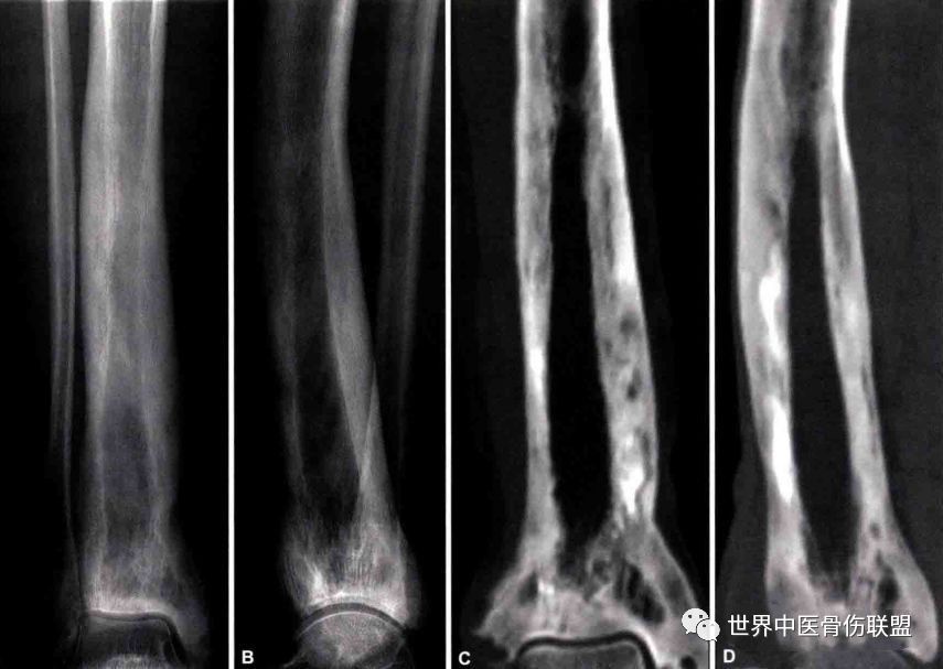 畸形性骨炎