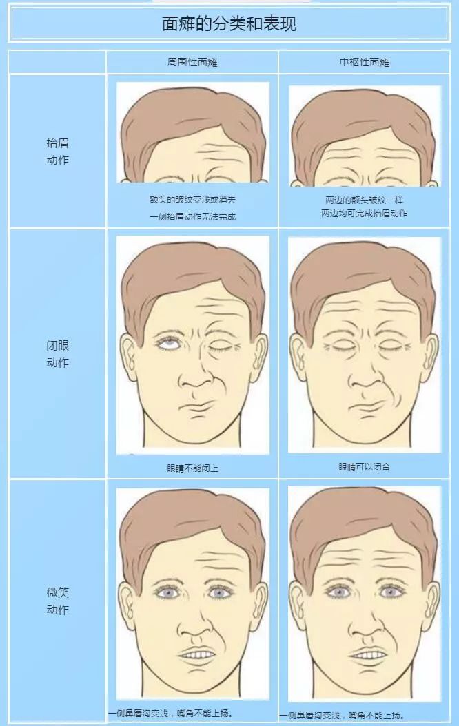 【阳光·科普】居家隔离期间如何进行面瘫自我训练