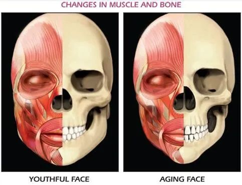 脸的老化松弛下垂，不只是因为胶原蛋白，还有骨骼肌肉以及...