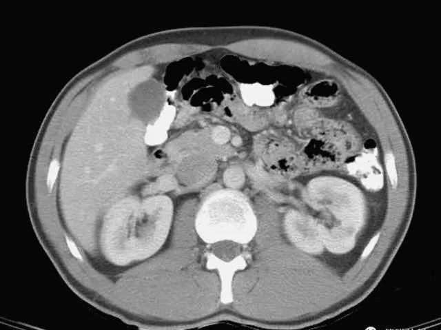 上腹部ct基础读片36张,看完就会了!