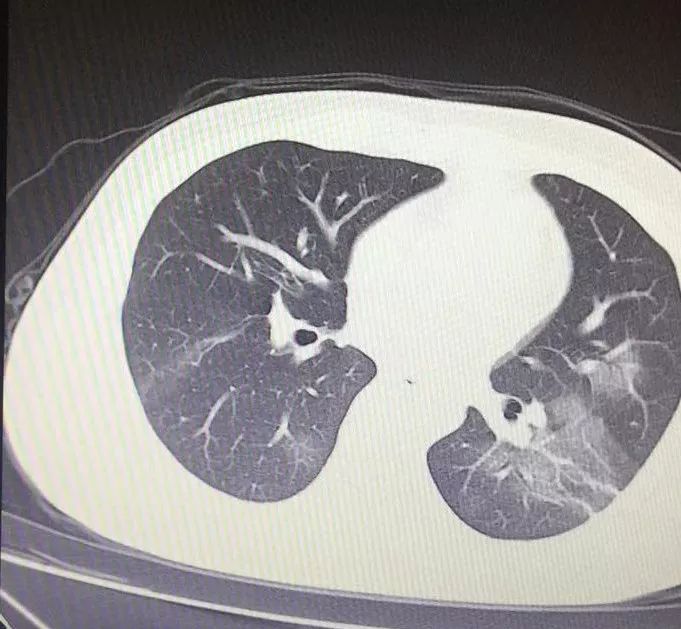 典型的病毒性肺炎ct片是这样: 总结其特点,简单来说就是:这个病ct