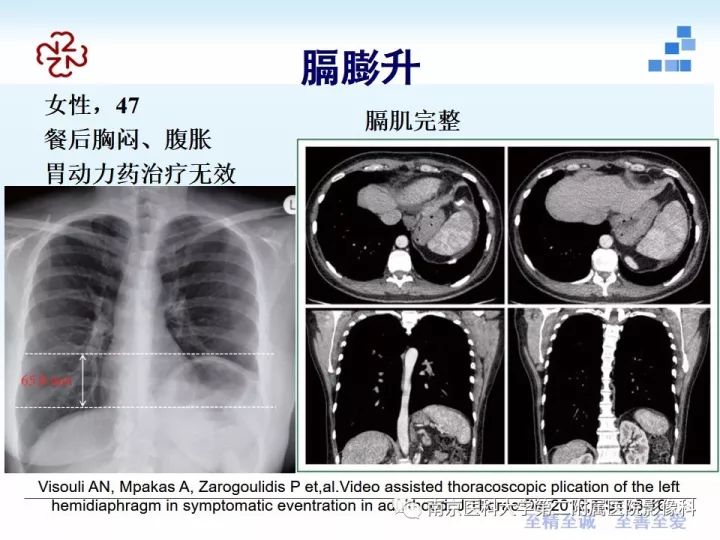 膈肌的解剖及常见病变影像表现