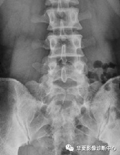 含有以上四型中的两种以上 显性脊柱裂:椎管内容从骨缺损处膨出  分