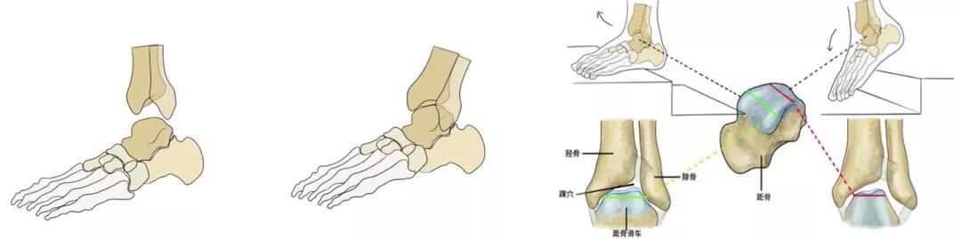 踝关节扭伤主要损伤的是侧副韧带,外踝比内踝承受更大的力,而外副