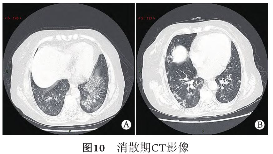 新冠肺炎的ct典型和不典型表现以及影像学分期