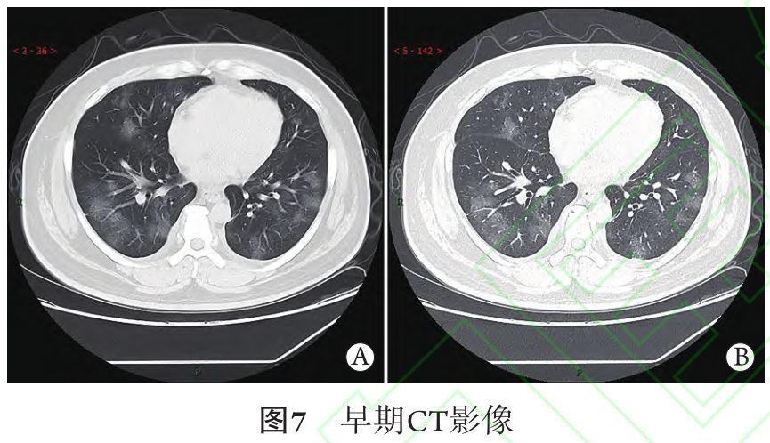 新冠肺炎的ct典型和不典型表现以及影像学分期