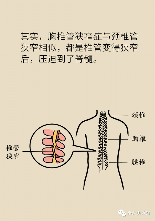 步履蹒跚不一定是脑血栓,也可能是胸椎管狭窄!