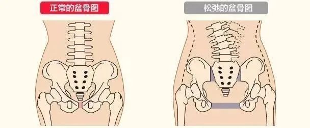 练出马甲线的谢娜却被产后骨盆前倾拖累到小腹暴突还有救吗