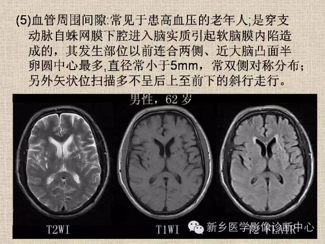 如何区分脉络膜裂囊肿蛛网膜囊肿血管间隙神经上皮囊肿还是侧脑室局部