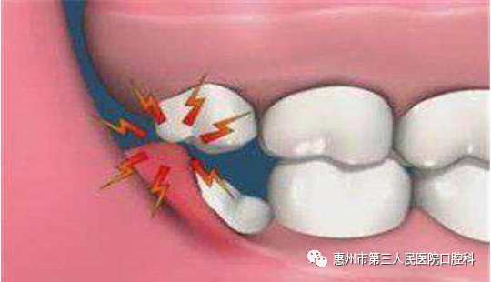 胀痛不适,咀嚼,吞咽,张口活动时疼痛加剧,检查可见智齿和磨牙后区肿胀
