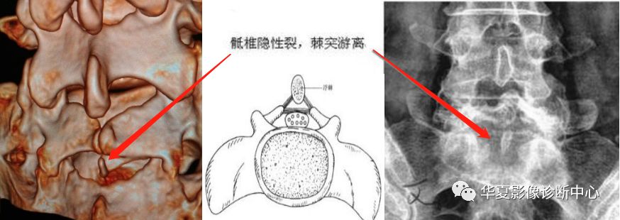 隐性脊柱裂合并椎管内的脊髓畸形者则称为脊髓发育不良,常见部位于腰