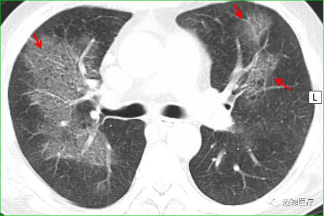 从基础到临床详解肺间质病变基本CT表现