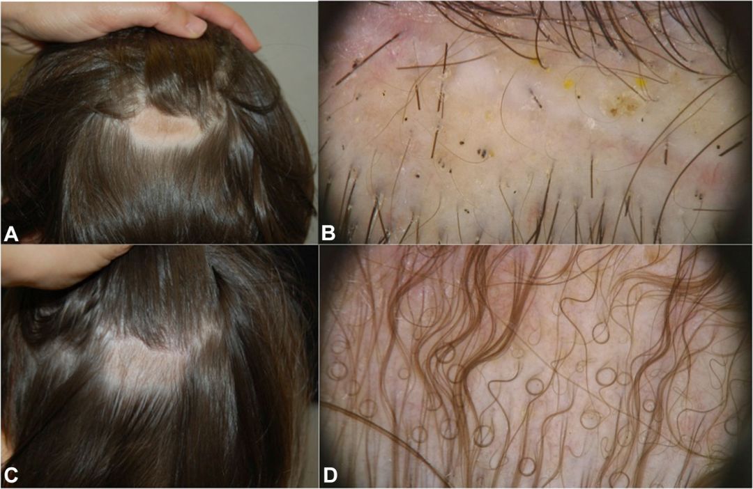 12例儿童及成人压力性脱发的临床及毛发镜表现_镜检查