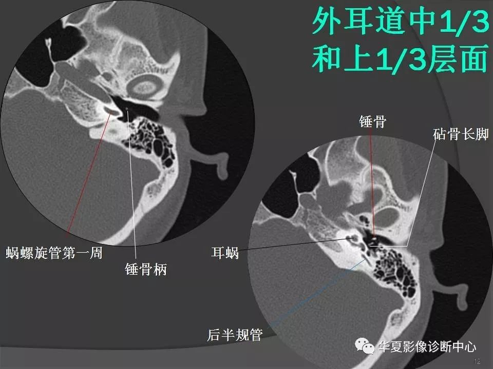 颞骨解剖及ct三维重建