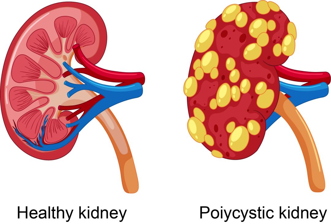 科研绘图多囊肾脏