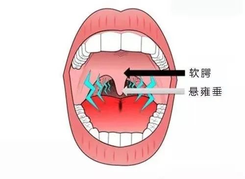 关于软腭运动的训练,家长们在家可以做哪些活动呢?