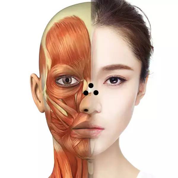 中等程度的鱼尾纹需要距眼眶外侧约1cm注射一列3-4个注射点,如果延伸