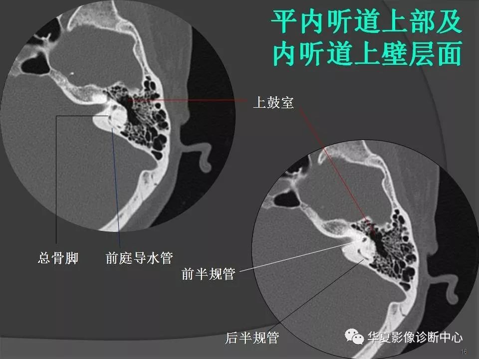 颞骨解剖及ct三维重建