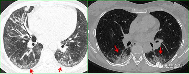 从基础到临床详解肺间质病变基本CT表现