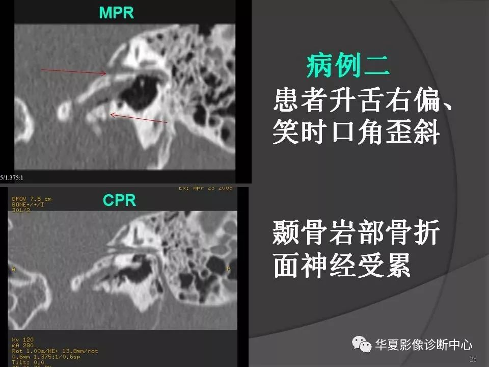 颞骨解剖及ct三维重建