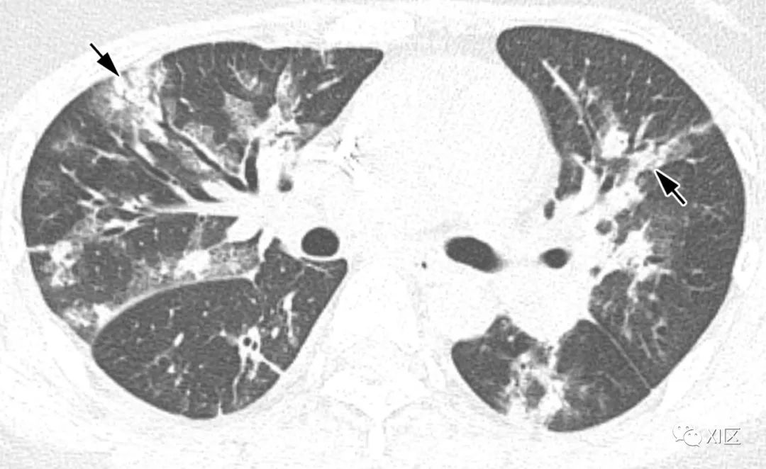 hpiv肺炎ct表现为多灶性斑片实变影伴ggo,使区分病毒与细菌性肺炎更加