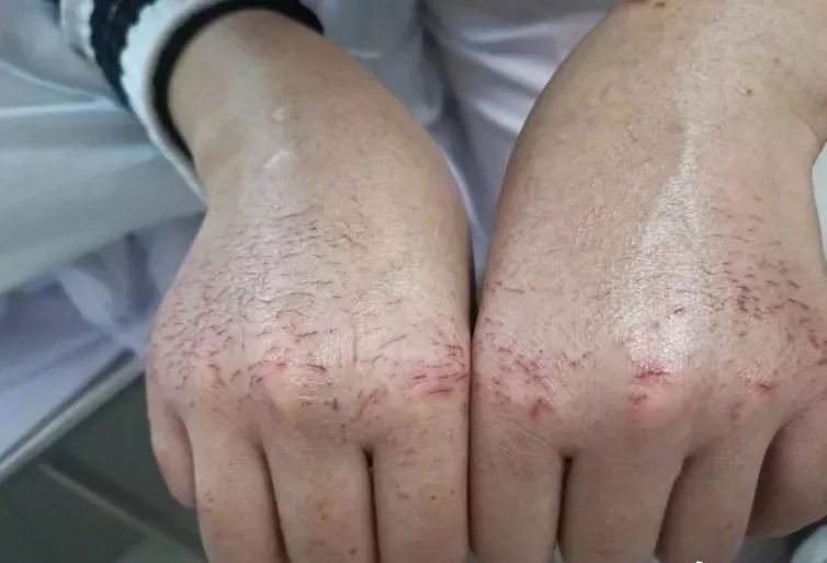 有什么方法可以缓解瘙痒 fac14f81879948089a51da20b80114d6.jpeg