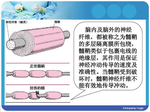 脱髓鞘的克星李氏生髓固鞘汤