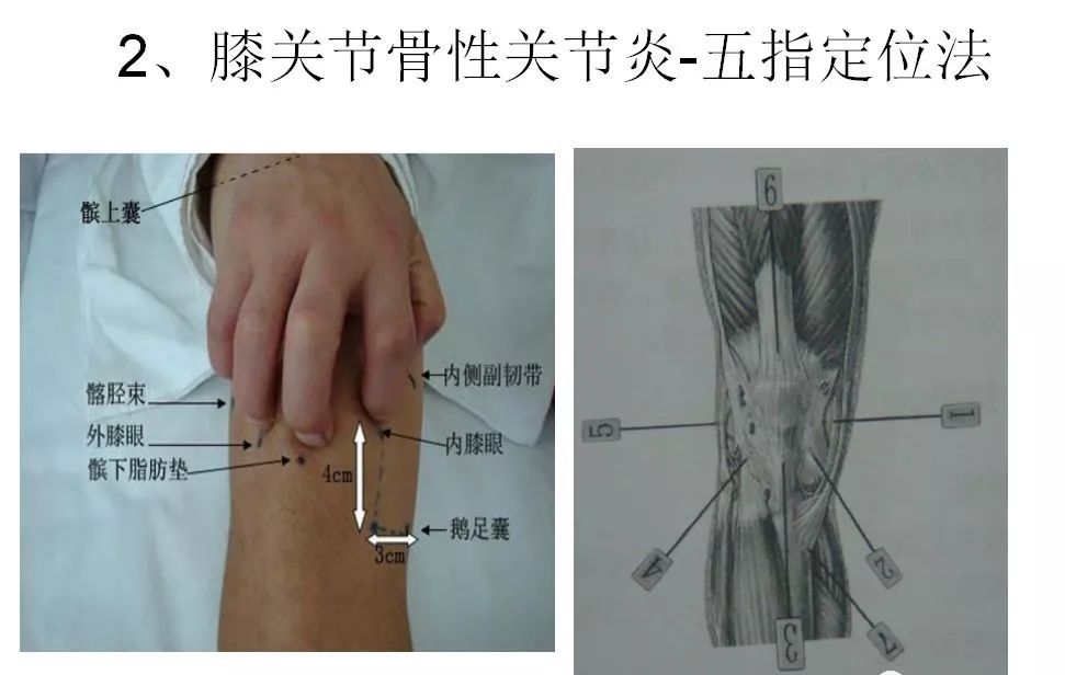 最后膝关节力平衡失调又使膝关节本身出现骨刺,髌下脂肪垫炎症,滑膜炎