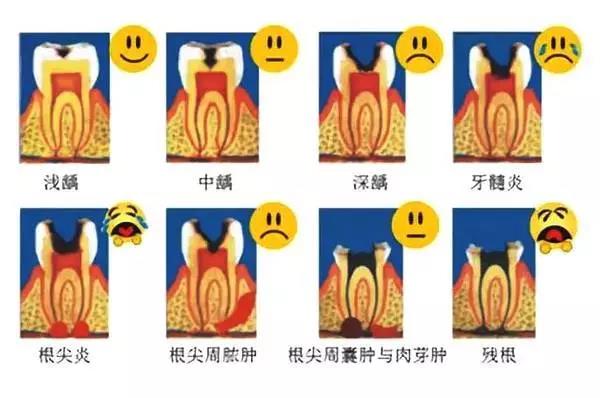 蛀牙不严重,自己能好吗?